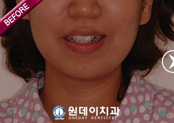 수술 전