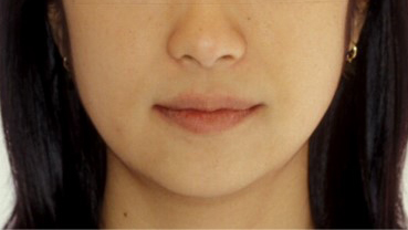 수술 후