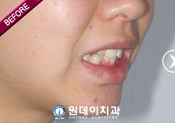 수술 전