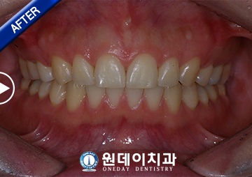 수술 후
