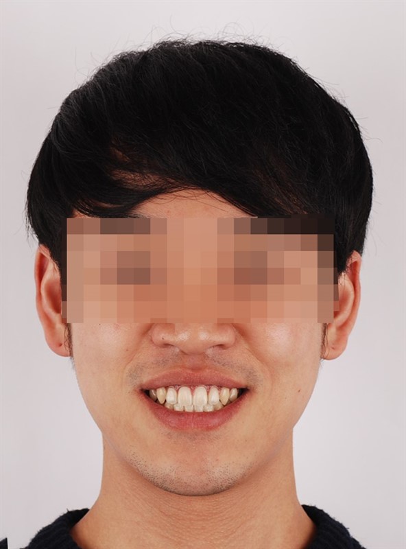 수술 후