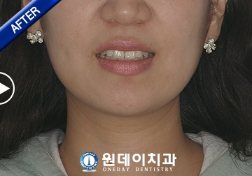 수술 후