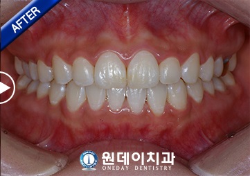 수술 후