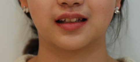 수술 전