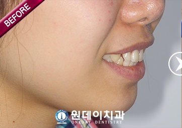 수술 전