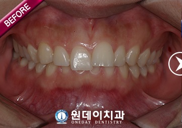 수술 전