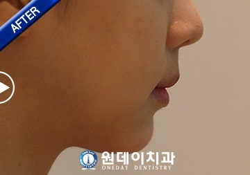 수술 후