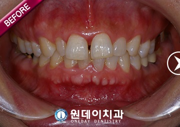 수술 전