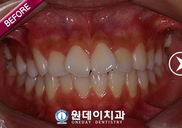 수술 전