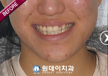 수술 전