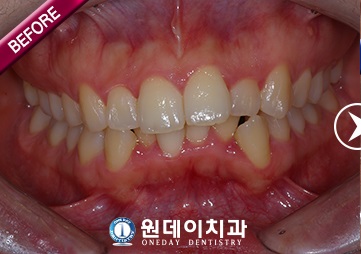 수술 전