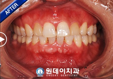 수술 후