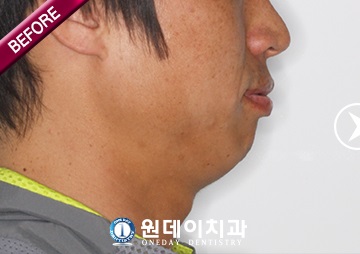 수술 전