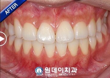 수술 후