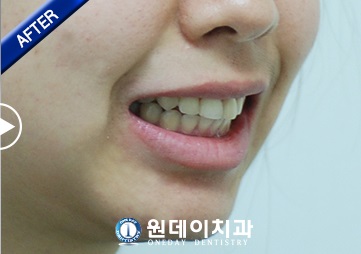 수술 후