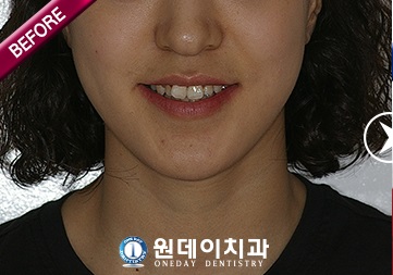 수술 전