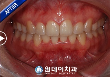 수술 후