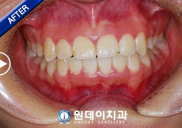 수술 후