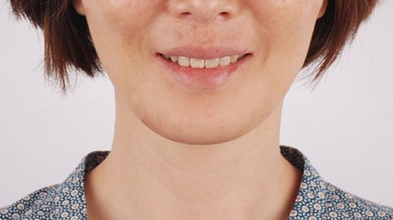 수술 후