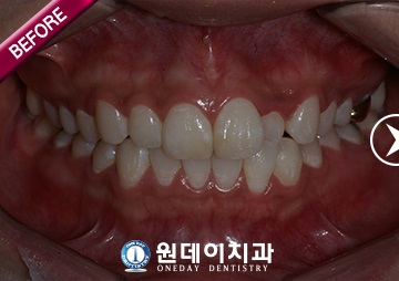 수술 전