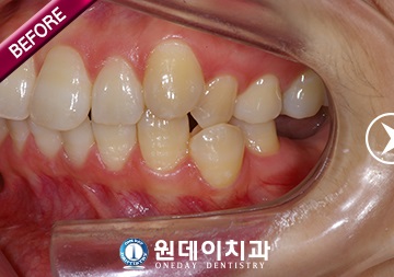 수술 전