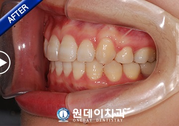 수술 후