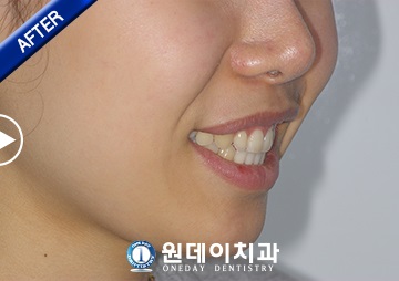 수술 후