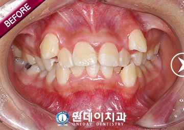 수술 전